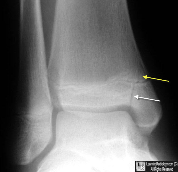 salter harris type IV ankle